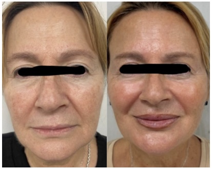 PRP — skin rejuvenation — before and after