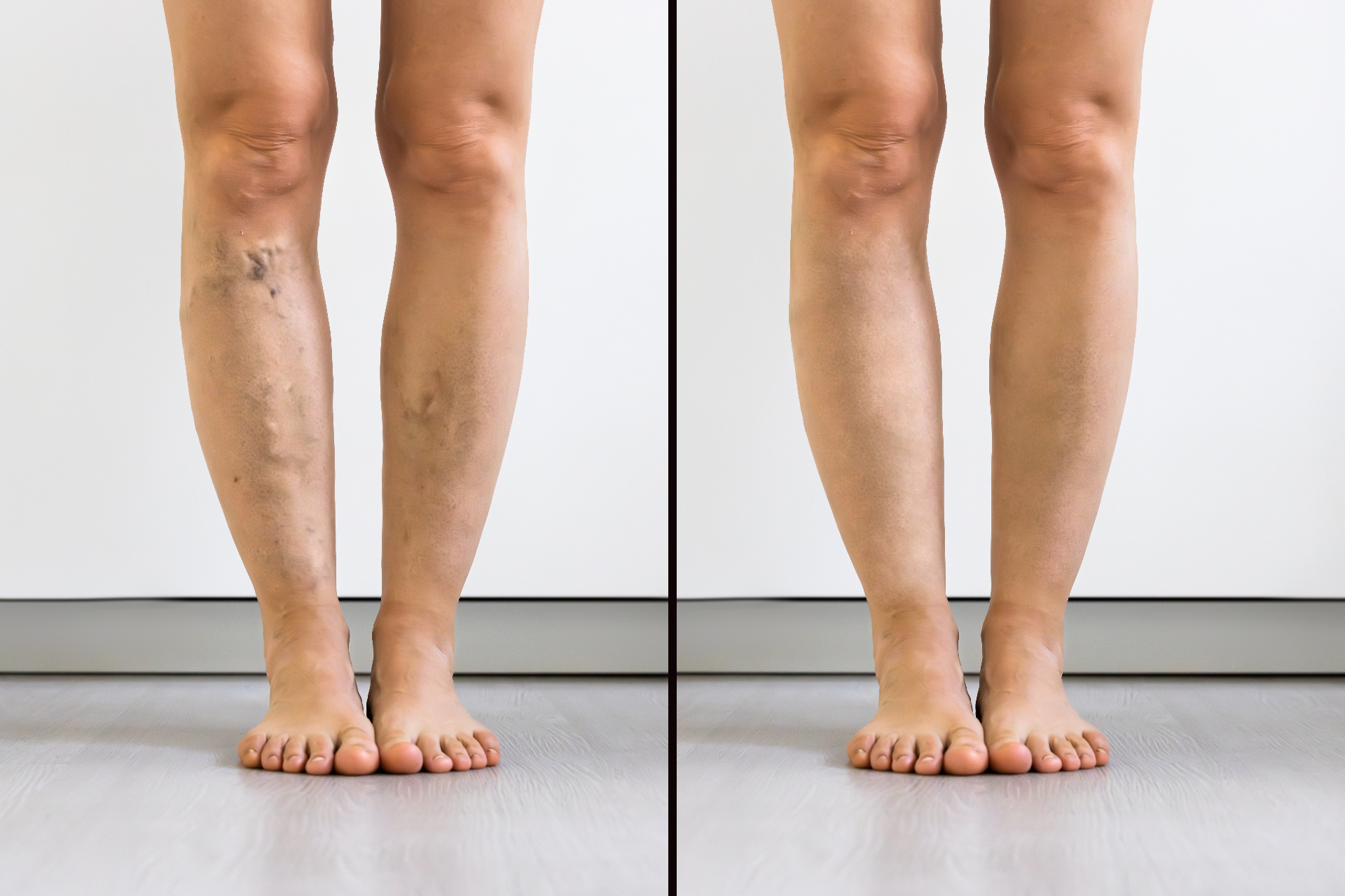 Radio Frequency for Varicose Veins — before and after