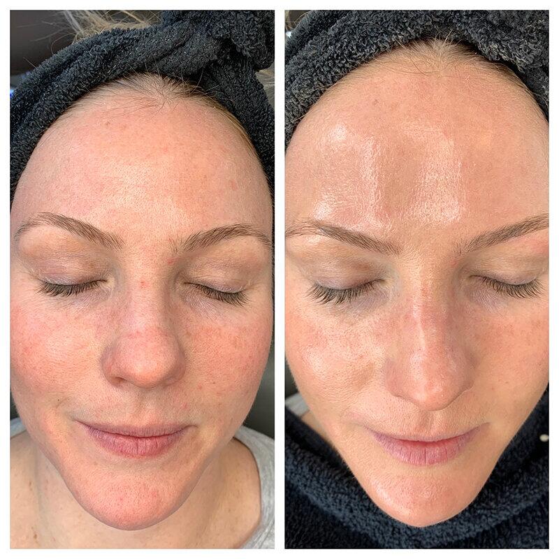 Medical Hydrafacial — before and after