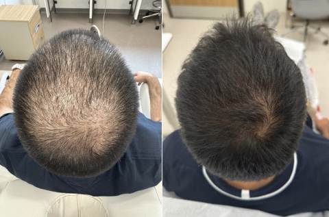 PRP — hair restoration — before and after